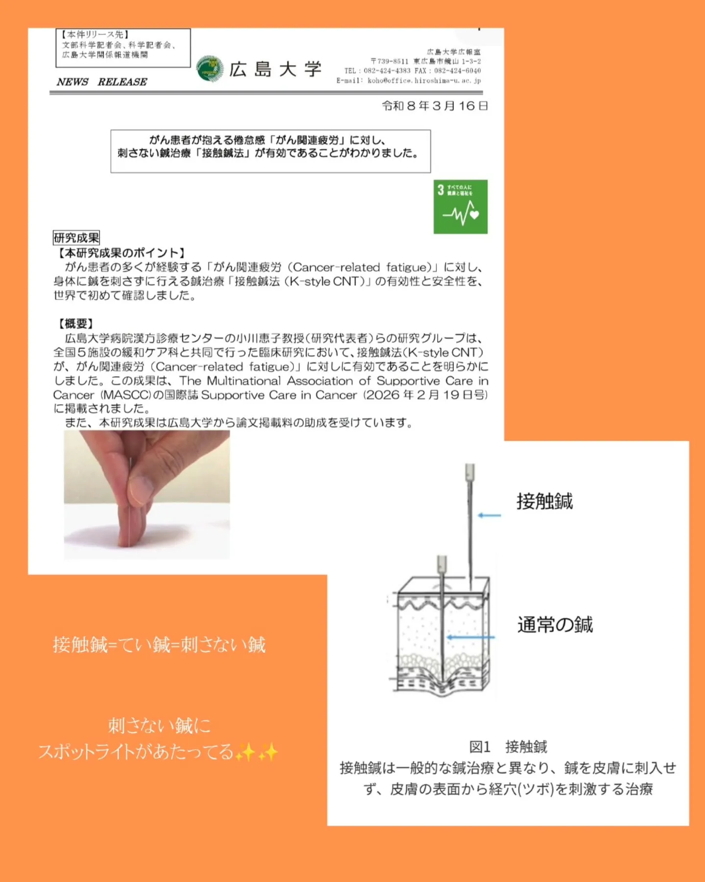 【てい鍼が注目されています✨】